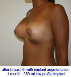 plastic-surgery-breast-lift-augmentation